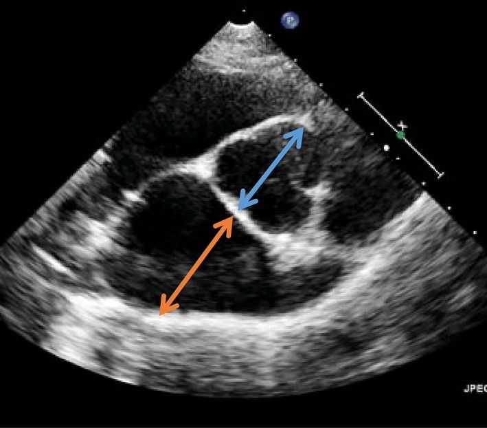 Nouveau consensus ACVIM 2019 concernant la Maladie Valvulaire Dégénérative et l’Hypertension Artérielle Pulmonaire